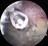صورة توضيحية لـ الاستئصال العظمي الدقيق