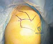 صورة توضيحية لـ استئصال الجزء البعيد من الترقوة بالمنظار: حل دائم لآلام مفصل الكتف المزمنة في صنعاء