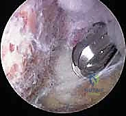 Arthroscopic Distal Clavicle Resection: An Intraoperative Masterclass for AC Joint Pathology