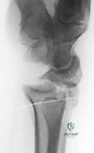 الدكتور محمد هطيف أثناء إجراء عملية تنظير دقيقة في صنعاء