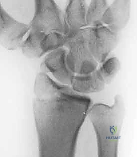Arthroscopic Reduction and Fixation of Distal Radius and Ulnar Styloid Fractures