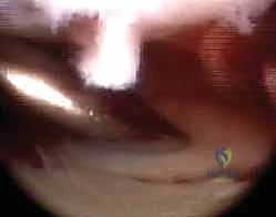 تأثير هشاشة العظام على كسور الكعبرة والزند