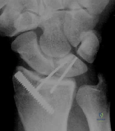 خيارات علاج كسور الرسغ والتثبيت بالجبس