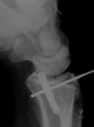 أجهزة التنظير الدقيقة المستخدمة في عمليات الرسغ