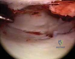 الجراحات التقليدية مقابل التقنيات الحديثة