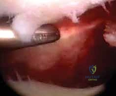 الأعراض السريرية لكسور الكعبرة والزند الإبري