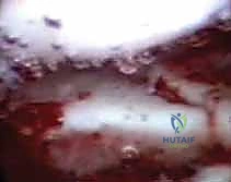 النتائج التجميلية والوظيفية الممتازة بعد التنظير