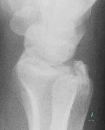 خطوات إدخال المنظار ورد الكسر بدقة