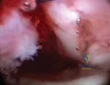 تثبيت الكسر باستخدام الأسلاك والشرائح الدقيقة