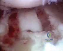 صورة توضيحية لـ تنظير مفصل الرسغ لتثبيت كسور الكعبرة البعيدة والزند الإبري: دليل شامل للمرضى مع الأستاذ الدكتور محمد هطيف