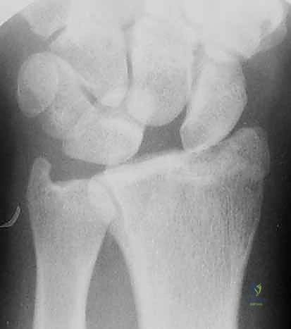 رؤية واضحة للسطح الغضروفي عبر شاشة المنظار 4K