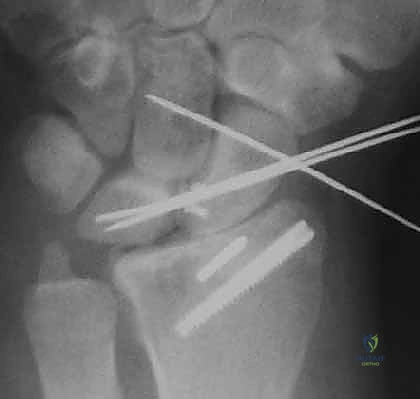 صورة توضيحية لـ تنظير مفصل الرسغ لتثبيت كسور الكعبرة البعيدة والزند الإبري: دليل شامل للمرضى مع الأستاذ الدكتور محمد هطيف