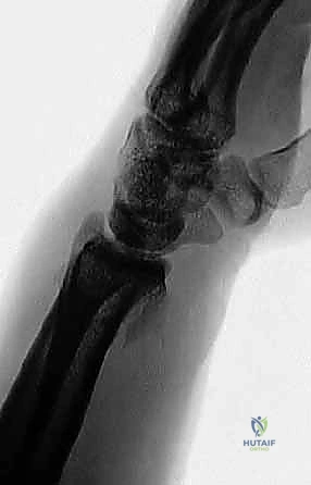 أنواع كسور الرسغ وآليات السقوط