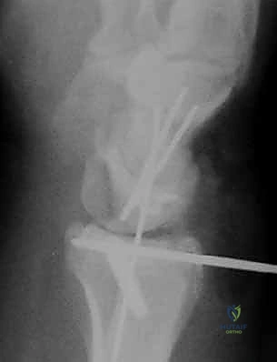 صورة توضيحية لـ تنظير مفصل الرسغ لتثبيت كسور الكعبرة البعيدة والزند الإبري: دليل شامل للمرضى مع الأستاذ الدكتور محمد هطيف