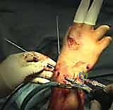 تجهيز المريض وجهاز الشد لعملية تنظير الرسغ