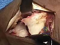 تخطيط العلاج الجراحي لكسور الكعبرة مع الدكتور هطيف