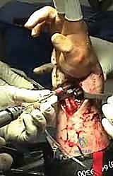 مقارنة الندبات بين الجراحة المفتوحة والمنظار