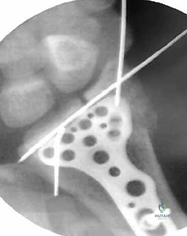 صورة توضيحية لـ تنظير مفصل الرسغ لتثبيت كسور الكعبرة البعيدة والزند الإبري: دليل شامل للمرضى مع الأستاذ الدكتور محمد هطيف