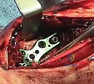 التشوه الشكلي للرسغ بعد الإصابة