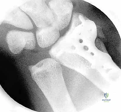 صورة توضيحية لـ تنظير مفصل الرسغ لتثبيت كسور الكعبرة البعيدة والزند الإبري: دليل شامل للمرضى مع الأستاذ الدكتور محمد هطيف