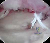 استعادة قوة القبضة والعودة للحياة الطبيعية