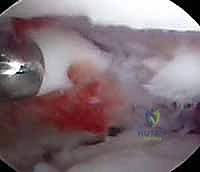 صورة توضيحية لـ تنظير مفصل الرسغ لتثبيت كسور الكعبرة البعيدة والزند الإبري: دليل شامل للمرضى مع الأستاذ الدكتور محمد هطيف