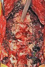 توضيح لأسباب الضغط على الحبل الشوكي