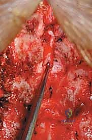 مقارنة بين الخيارات الجراحية