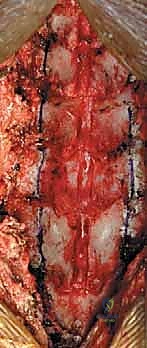 الشق الجراحي والوصول للعظام