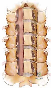 صورة توضيحية لـ رأب الصفيحة العنقية في صنعاء دليل شامل لفك ضغط العمود الفقري واستعادة الحركة مع الأستاذ الدكتور محمد هطيف