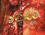 صورة توضيحية لـ رأب الصفيحة العنقية في صنعاء دليل شامل لفك ضغط العمود الفقري واستعادة الحركة مع الأستاذ الدكتور محمد هطيف