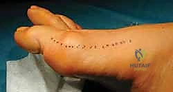 صورة توضيحية لـ جراحة لودلوف لتصحيح إبهام القدم الأروح (الوكعة): استعادة الراحة والحركة مع الأستاذ الدكتور محمد هطيف في صنعاء