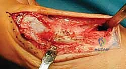 صورة توضيحية لـ جراحة لودلوف لتصحيح إبهام القدم الأروح (الوكعة): استعادة الراحة والحركة مع الأستاذ الدكتور محمد هطيف في صنعاء