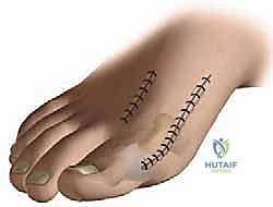 جراحة لودلوف لتصحيح إبهام القدم الأروح (الوكعة): استعادة الراحة والحركة مع الأستاذ الدكتور محمد هطيف في صنعاء