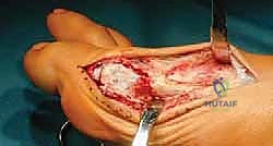 صورة توضيحية لـ جراحة لودلوف لتصحيح إبهام القدم الأروح (الوكعة): استعادة الراحة والحركة مع الأستاذ الدكتور محمد هطيف في صنعاء