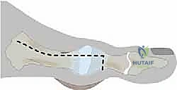 صورة توضيحية لـ جراحة لودلوف لتصحيح إبهام القدم الأروح (الوكعة): استعادة الراحة والحركة مع الأستاذ الدكتور محمد هطيف في صنعاء