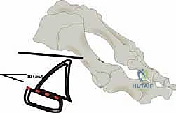 صورة توضيحية لـ جراحة لودلوف لتصحيح إبهام القدم الأروح (الوكعة): استعادة الراحة والحركة مع الأستاذ الدكتور محمد هطيف في صنعاء