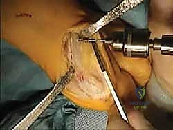 صورة طبية: جراحة لودلوف لتصحيح إبهام القدم الأروح (الوكعة): استعادة الراحة والحركة مع الأستاذ الدكتور محمد هطيف في صنعاء