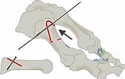 صورة طبية: جراحة لودلوف لتصحيح إبهام القدم الأروح (الوكعة): استعادة الراحة والحركة مع الأستاذ الدكتور محمد هطيف في صنعاء