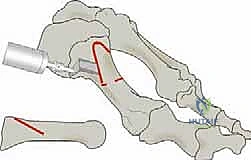 صورة طبية: جراحة لودلوف لتصحيح إبهام القدم الأروح (الوكعة): استعادة الراحة والحركة مع الأستاذ الدكتور محمد هطيف في صنعاء