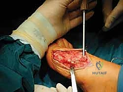 صورة طبية: جراحة لودلوف لتصحيح إبهام القدم الأروح (الوكعة): استعادة الراحة والحركة مع الأستاذ الدكتور محمد هطيف في صنعاء