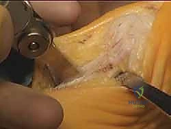 صورة طبية: جراحة لودلوف لتصحيح إبهام القدم الأروح (الوكعة): استعادة الراحة والحركة مع الأستاذ الدكتور محمد هطيف في صنعاء