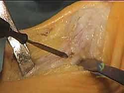 صورة توضيحية لـ جراحة لودلوف لتصحيح إبهام القدم الأروح (الوكعة): استعادة الراحة والحركة مع الأستاذ الدكتور محمد هطيف في صنعاء