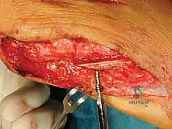 صورة طبية: جراحة لودلوف لتصحيح إبهام القدم الأروح (الوكعة): استعادة الراحة والحركة مع الأستاذ الدكتور محمد هطيف في صنعاء