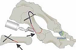 صورة طبية: جراحة لودلوف لتصحيح إبهام القدم الأروح (الوكعة): استعادة الراحة والحركة مع الأستاذ الدكتور محمد هطيف في صنعاء