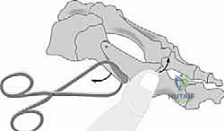 صورة طبية: جراحة لودلوف لتصحيح إبهام القدم الأروح (الوكعة): استعادة الراحة والحركة مع الأستاذ الدكتور محمد هطيف في صنعاء