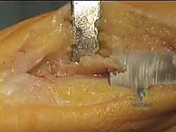 جراحة لودلوف لتصحيح إبهام القدم الأروح مع الأستاذ الدكتور محمد هطيف