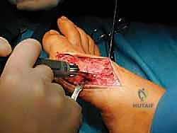 صورة طبية: جراحة لودلوف لتصحيح إبهام القدم الأروح (الوكعة): استعادة الراحة والحركة مع الأستاذ الدكتور محمد هطيف في صنعاء