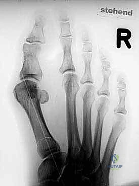 Illustration of hallux valgus angle - Dr. Mohammed Hutaif