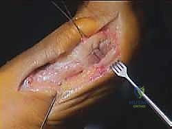 تفاصيل المفصل المشطي السلامي